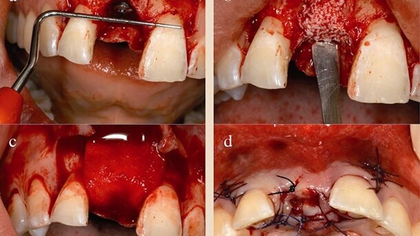 Neoss Implantat System mit klinischen und radiologischen 5-Jahres-Daten
