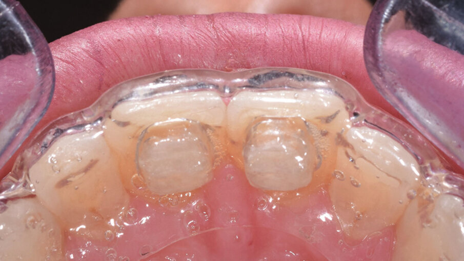 Fig. 6_Particolare del bite-ramp sottostante all’allineatore.