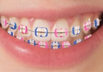 Clarity ADVANCED Ceramic Brackets