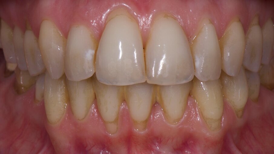 Fig. 9 - Pigmenti lievi e diffusi sulle superfici dentali.