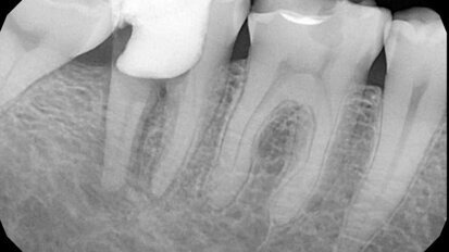 Riješavanje problema neuspjelog endodontskog liječenja zuba