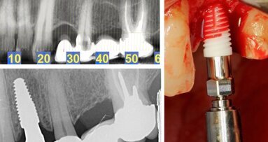 Rehabilitación estética en la región posterior con implantes cerámicos