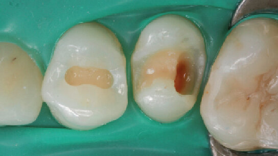 Vysoce kvalitní výplně. Moderní nano-hybridní kompozita – alternativa pro kavity všech tříd