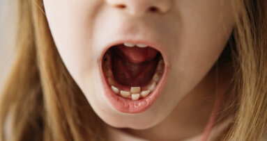 New study examines effects of different anti-cancer therapy on oral health