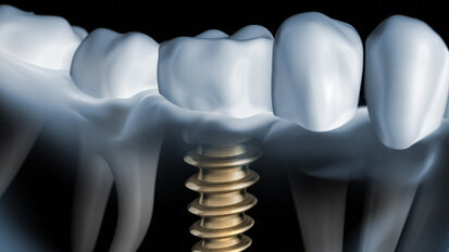 KKI: Indikationsklassen der Implantologie überarbeitet