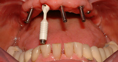 Riabilitazione mascellare full-arch  con strutture avvitate ATLANTIS ISUS  in un caso complesso dal punto di vista estetico