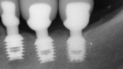 Gli impianti corti: un’opzione di successo nei trattamenti a breve termine