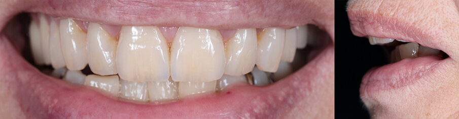 Figs: 13 and 14. View of the lips with inserted dentures in function.