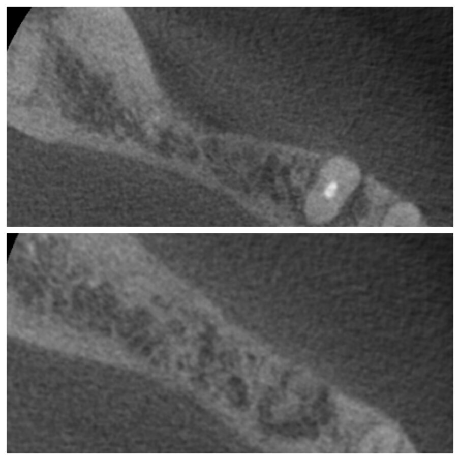Fig. 3c_CBCT pre intervento e dopo 6 mesi a confronto.