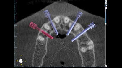 Fixní rekonstrukce celého oblouku nesená implantáty: Využití „full-template guidance technique