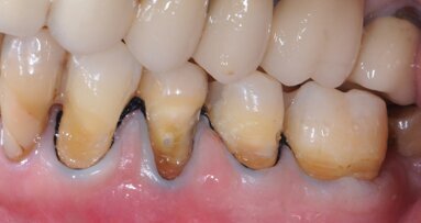 Amalgam: Gone for good?