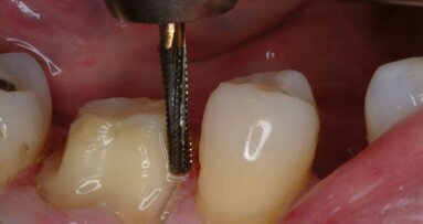 Zastosowanie narzędzi Great White Ultra Carbide w preparacji zębów pod korony