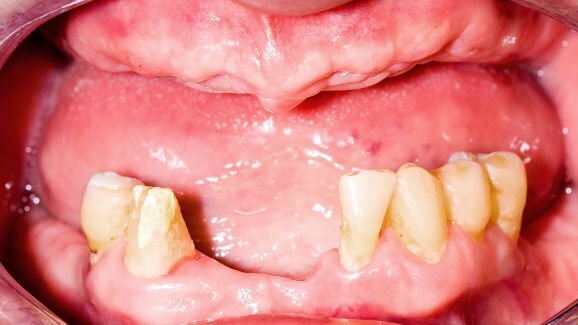 La perte de dents peut être associée à une fonction cognitive réduite