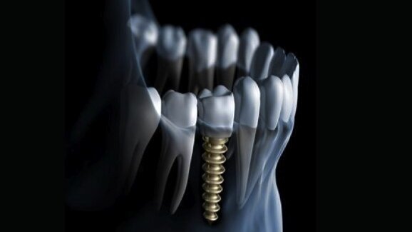 Secrets of successful dental implant placements