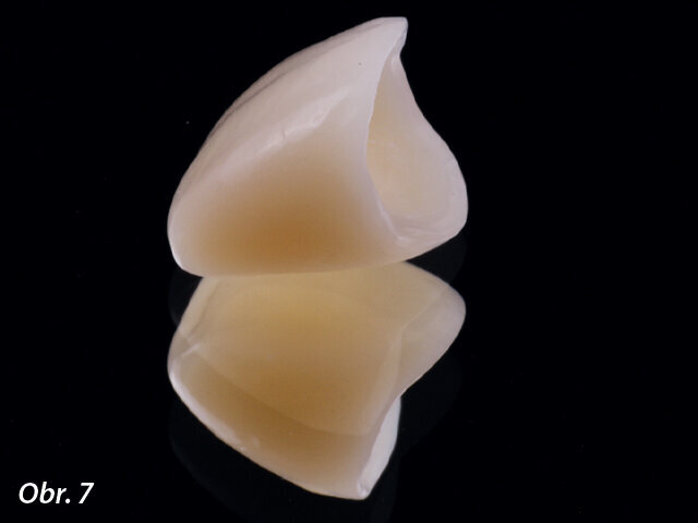 Provizorní korunky z materiálu Structur CAD