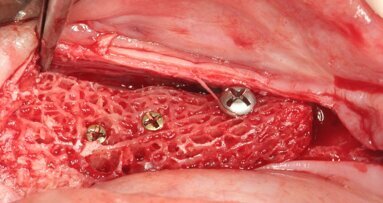 Webinar: Customized allogenic bone blocks improve outcome in bone augmentation