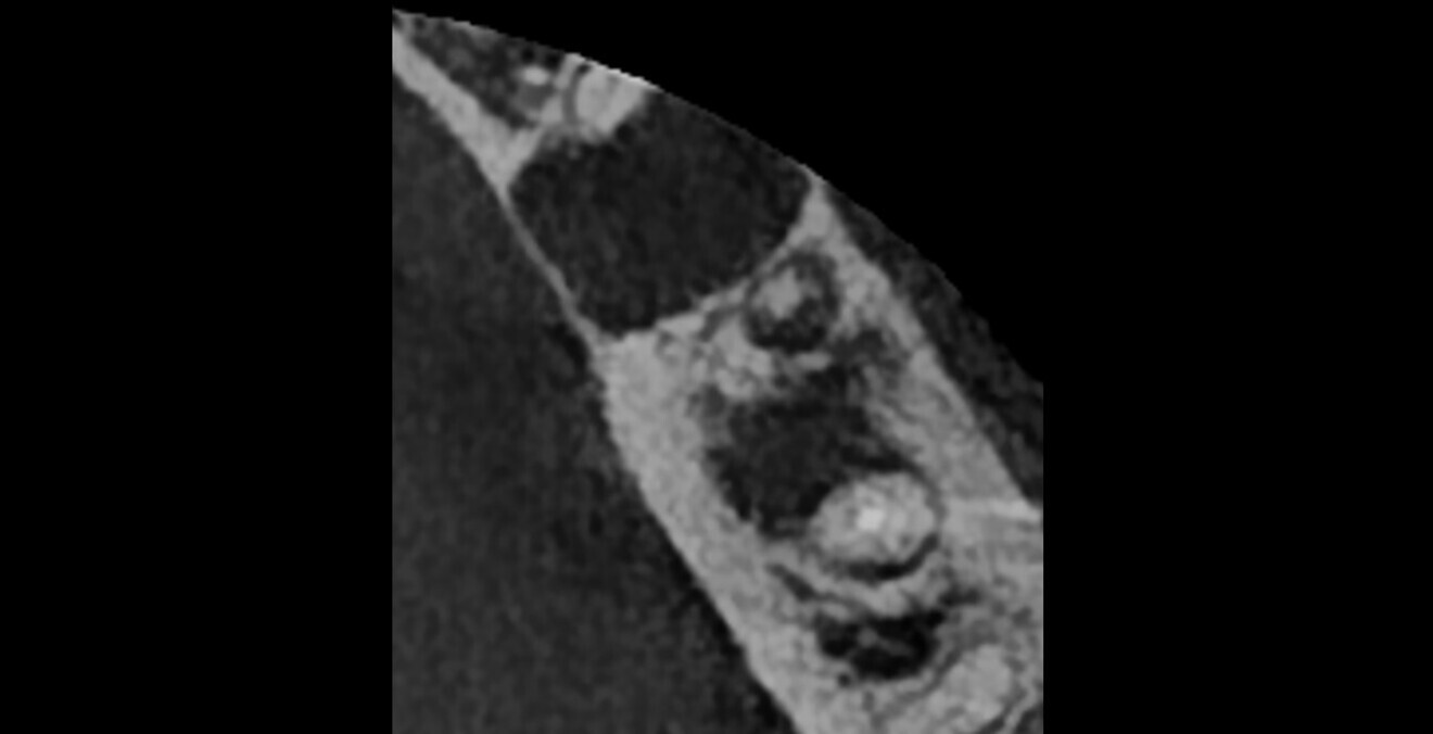 Fig. 5: The extent of the lesions and the separation between the lesions are clearly visible.