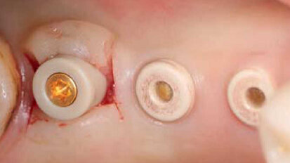 Piliers CAD/CAM individualisés sur implants en céramique