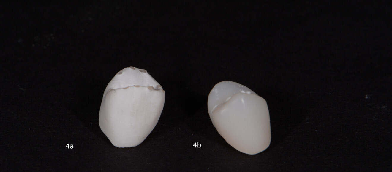Figs. 4a & b: Premolar restorations made from Rodin Sculpture. Printed, rinsed and polymerised premolar restoration (a). Premolar restoration after polishing (b).