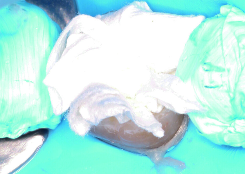 Fig. 13: Drying of tooth #46 with absorbent paper strips instead of airflow to avoid overdrying of the dentine.