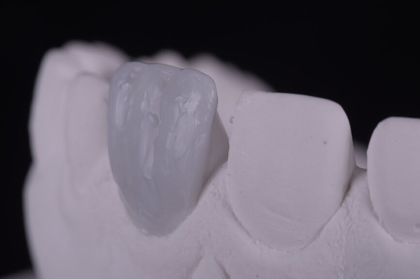 Fig. 26: Wax-up of the entire facial area, frontal and lateral views.