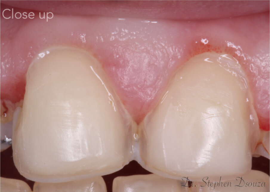 Fig. 11: Close up of preparation