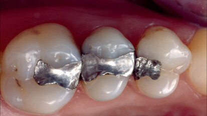 Cementování nepřímých estetických prací