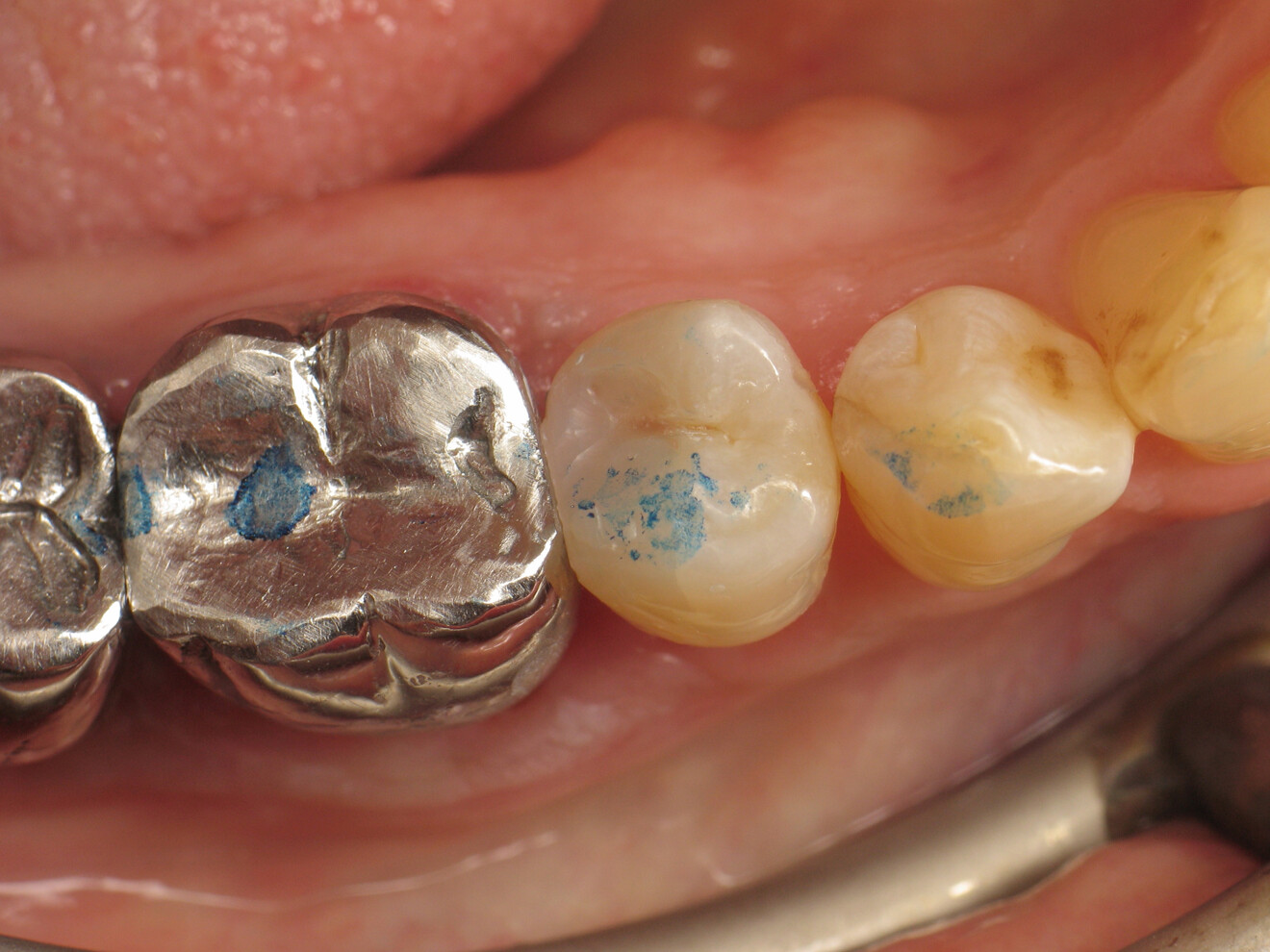 Fig. 21: Occlusion check after adjustments.