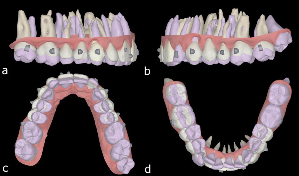 Figs. 45a–d: Pretreatment situation (purple) and expected post-treatment situation (white) in FAS OcclusalDesign.