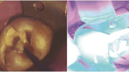 Biodentin „Jedan za sve“  -korak napred