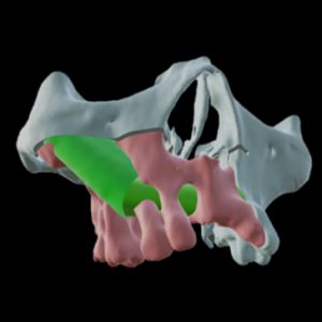 Fig. 2: Superimposition with fibula bone.
