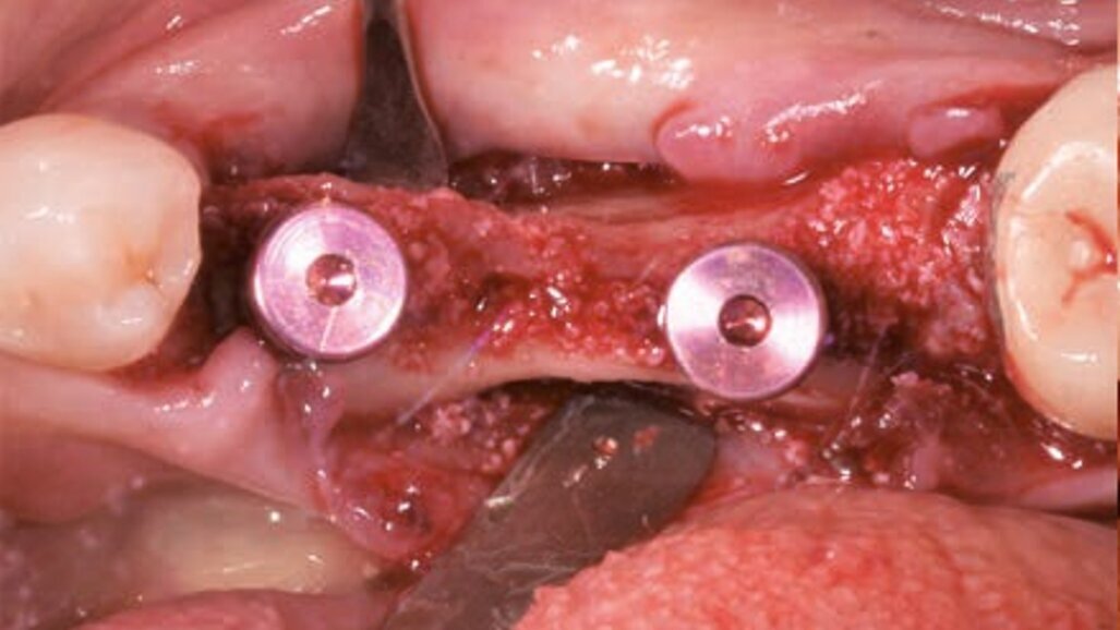 Riabilitazione implanto-protesica minimamente invasiva di una cresta atrofica mediante chirurgia guidata