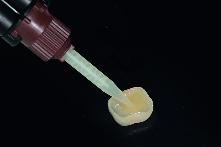 Fig. 11: Before seating the crown, a homogeneous and thin film of Calibra® Automix was placed on the inner surfaces of the crown.