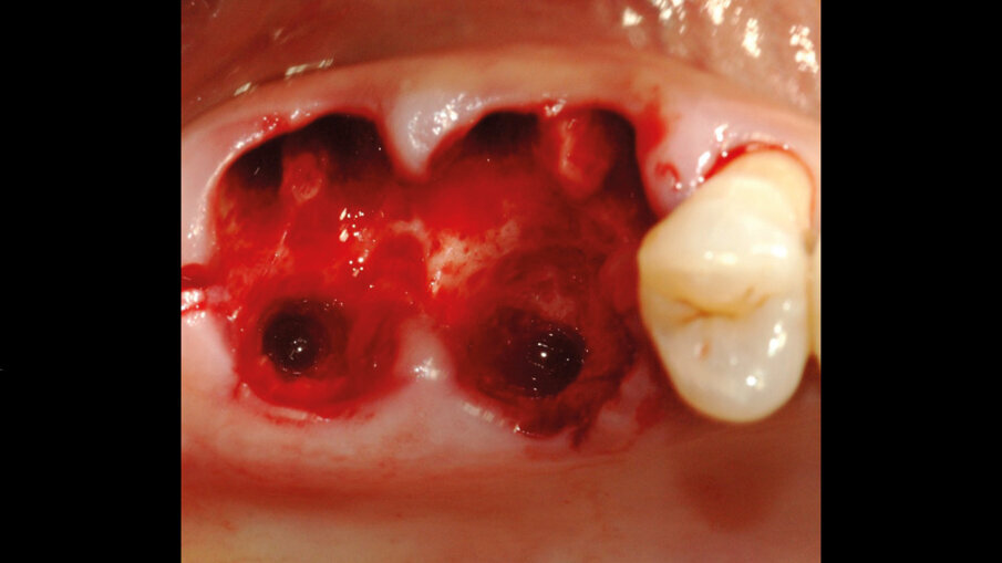 Fig. 2 - Estrazione dei due elementi compromessi.