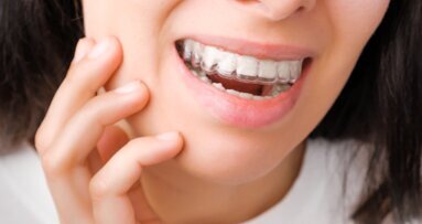 Allineatori trasparenti: uno studio esamina la perdita di ancoraggio durante la distalizzazione dei molari mascellari