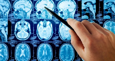 Infezioni dentali possono provocare degli aneurismi cerebrali