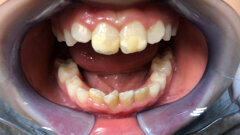 Curasept Biosmalto în stomatologia pediatrică: o abordare clinică a MIH și a îngrijirii ortodontice