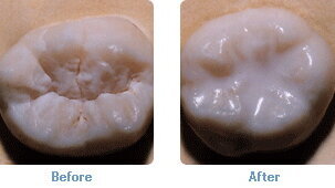 Dental sealants: They are not just for kids anymore