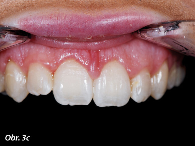 Gingivoplastika týden po operaci.