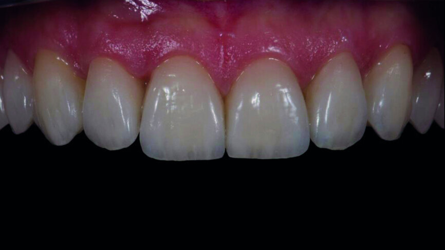 Fig. 15a: Feldspathic veneers with try-in paste.