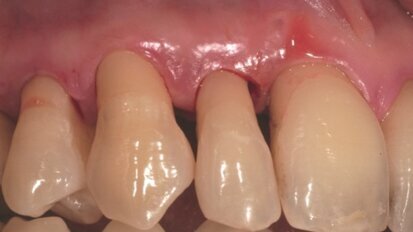 Zapobieganie głębokim chorobom przyzębia dzięki zastosowaniu lasera Er:YAG