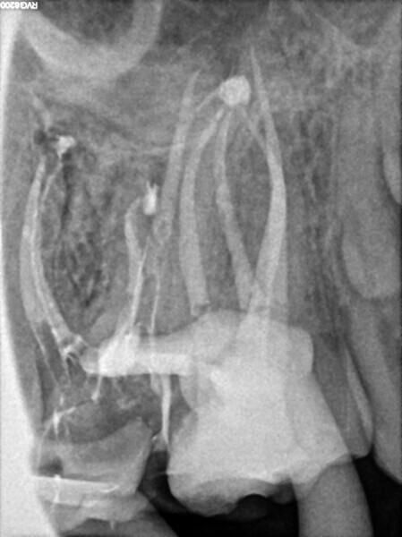 Fig. 60: Post-op radiograph showing the apical part of the MB2 canal filled with the sealer and the lateral canal in the palatal root.