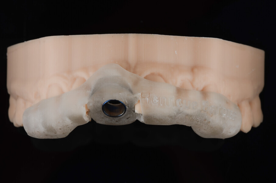 Fig. 11a: Try-in of the surgical guide on the resin model, anterior view.