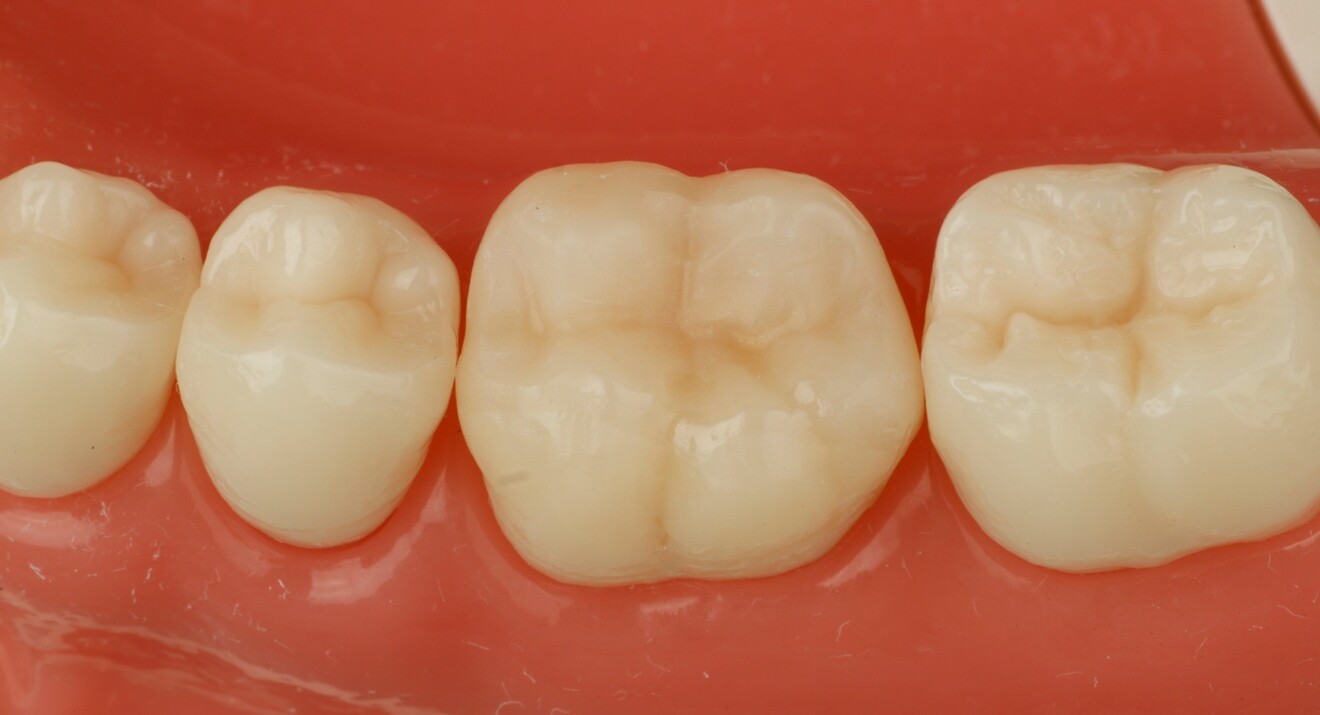 Fig. 2d: Cementation with Calibra Universal+ resin cement. 