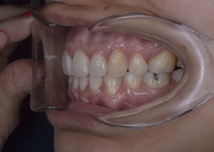 Fig. 7d: Final intra-oral photographs.