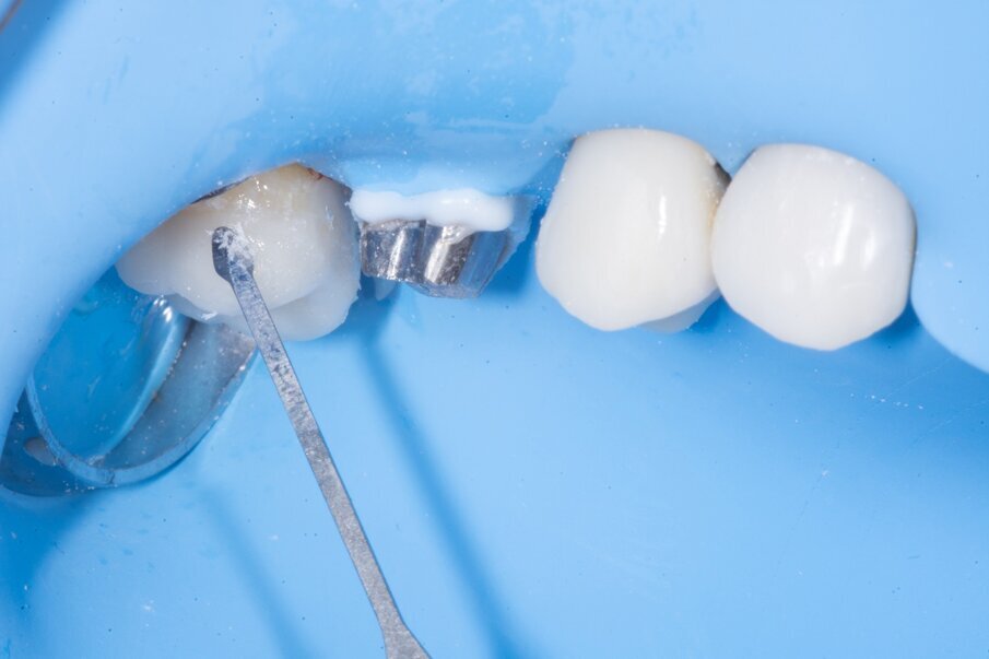Fig. 17: Finishing of the margins using a size 4 spoon blade.