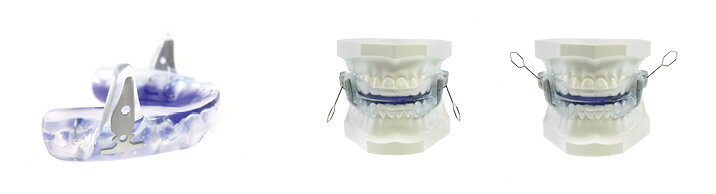 Předsunutí mandibuly a jazyka