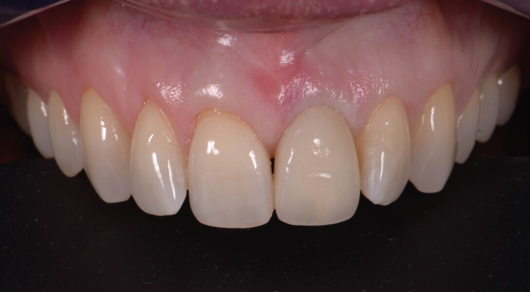 Fig. 20a : Couronne définitive implanto-portée, vue extraorale ; 