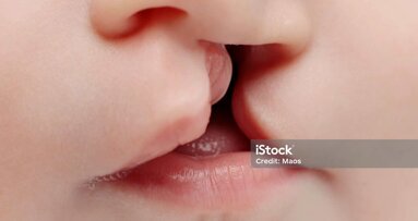 Crianças com fenda labiopalatina apresentam melhores resultados quando intervencionadas precocemente