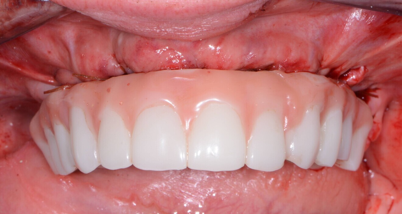 Fig. 12: Maxillary provisional restoration in situ.